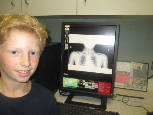 Sprained arm on carpoolcandy.com