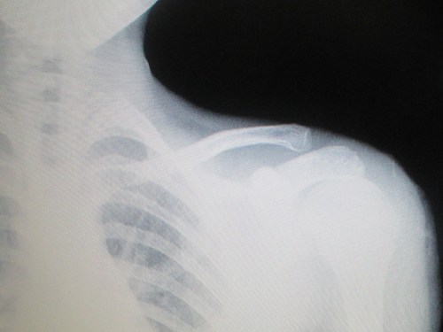 Sprained arm on carpoolcandy.com